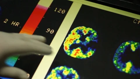 Doctor is checking Brain Image on Touch Screen Monitor. 스톡 동영상 100599016
