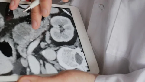 Doctor checking ct of the abdominal cavity Stock Footage 87517955