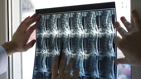 The doctor checks the spine x-ray Stock Footage