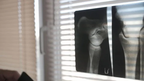 Doctor comparing two x-ray in the hospital Stock Footage 115256024