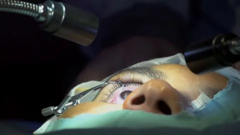 Doctor conducting Lasik surgery Stock Footage 123719587