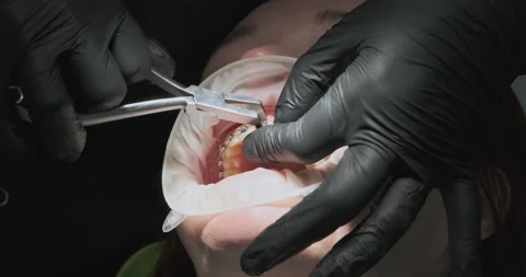 Doctor dentist, hands is trying to remove glued braces upper jaw patient's teeth Stock Footage 245143833