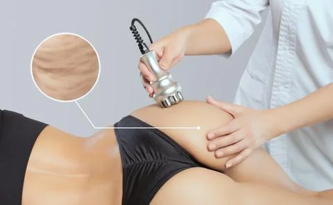 The doctor does the Rf lifting procedure on the legs, buttocks and hips of a  Stock Photos