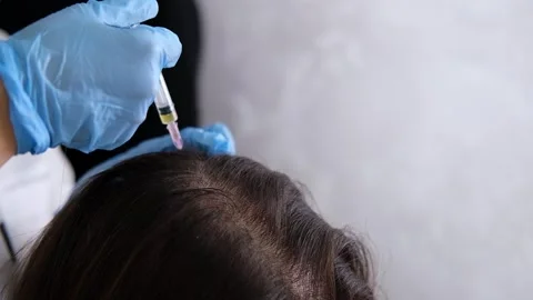 Doctor is doing a plasma therapy injecting head for healthy hair growth Vídeos de archivo 319294705