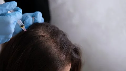 Doctor is doing a plasma therapy injecting head for healthy hair growth Stock Footage 319649505
