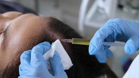 Doctor is doing a plasma therapy injecting head for healthy hair growth Stock Footage 319649527