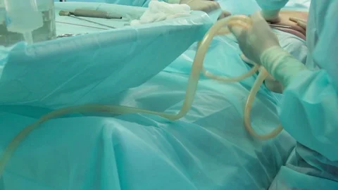 Doctor, during a plastic operation, suck fat from the patient Stock-Footage 70003381