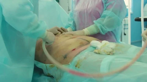 Doctor, during a plastic operation, suck fat from the patient Stock Footage 70003582