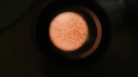 Doctor examines the birthmark on the body through a microscope Stock Footage