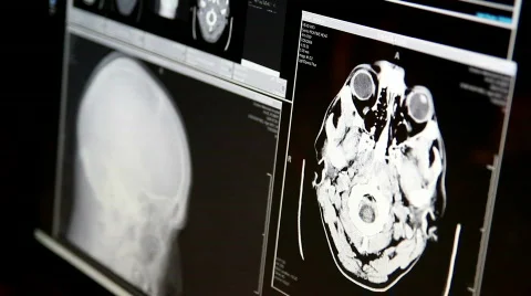 Doctor Examines MRI Images on Computer Screen Stock Footage