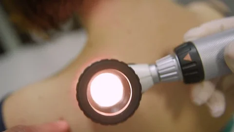The doctor examines the patient's mole Stock Footage