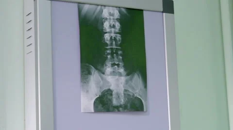 Doctor examines an X-ray of the backbone Stock Footage 42886772