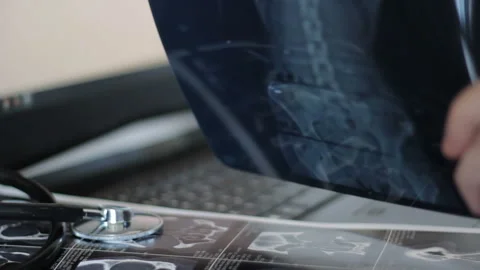 Doctor examines an x-ray of the spine with scoliosis Stock Footage 105229734