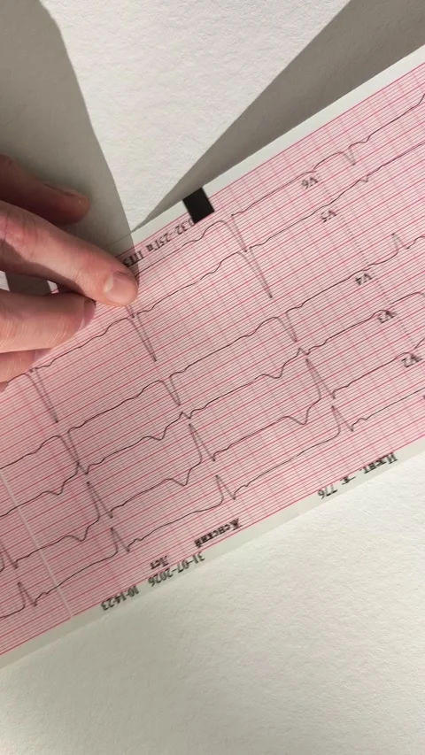 Doctor examining electrocardiogram results printed on paper to diagnose a p.. Stock Footage 346161017