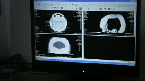 Doctor examining Neuroimaging at computer Stock Footage 12459056