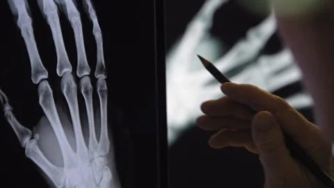 Doctor examining scan of hand Stock Footage 129851935