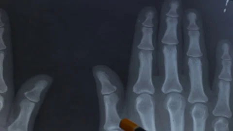 Doctor examining the x-ray of the hand. Stock Footage