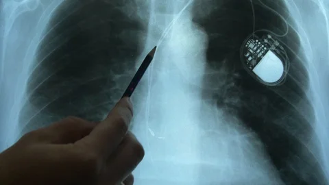 Doctor Examining X-Ray Image of Chest with Artificial Cardiac Pacemaker Implant 스톡 동영상 119452659