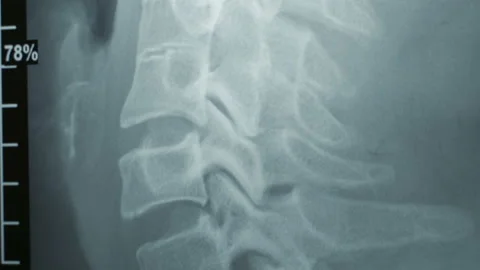 Doctor examining an x-ray of a patient's spine. Healthy easy men in the picture Stock Footage
