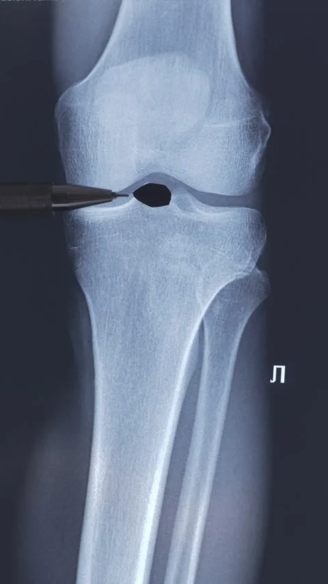Doctor examining X-ray scan of knee joint. Stock Footage 313660450