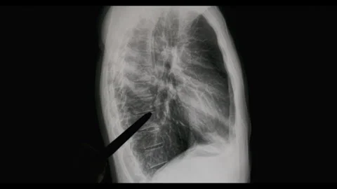 A doctor explain with a pointer the x-ray of healthy middle-aged man Видео 277506865