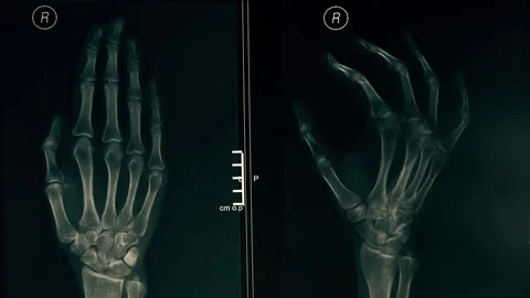 Doctor explaining x-ray image of a hand to a patient. 4K close-up video Stock Footage 72400466