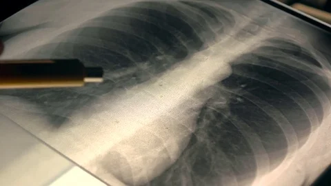 Doctor explaining x-ray image of a chest to a patient. 4K close-up video Stock Footage 72400747