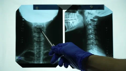 Doctor explains problems in the vertebrae by showing on snapshot Stock Footage 237186098