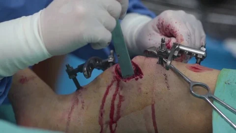 Doctor forceps pulls part of the bone from the leg of the patient Stock Footage 73037958