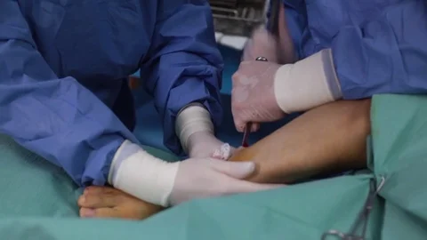 Doctor a hammer and chisel to break the bone legs of a patient. open fracture Video stock 73040152