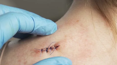 Doctor hands checking stitches after mold removal surgery on woman shoulder Video stock 150675687