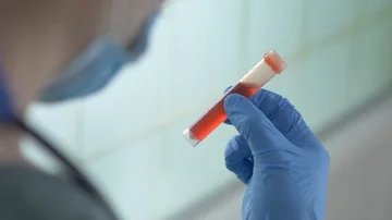 Doctor Holding a Blood Sample Test Tube and Looking at It Stock Footage 86093449