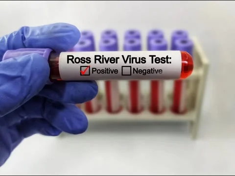 Doctor holding a test blood sample tube with Ross River Virus test Stock Footage 296902893