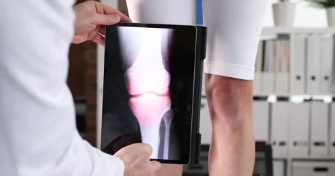 Doctor holds tablet displaying X-ray image of patient knee joint Stock Footage 307908077