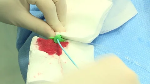 Doctor inserting needle in patient's arm Stock Footage 45900282