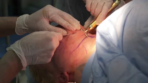Doctor inserts a long surgical needle into the patient's skin for liposuction Stock Footage 167295392