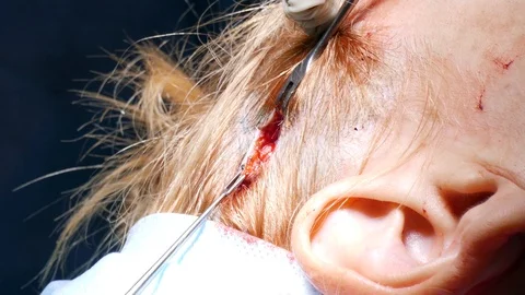 The doctor inserts a metal scraper into the hole in the scalp and raises the ski Stock Footage 123575579