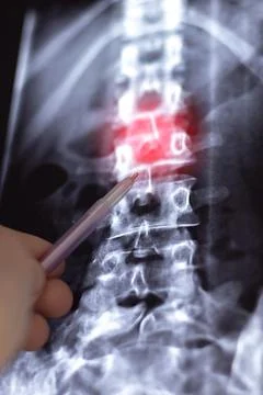 Doctor learn Vertical X-ray or MRI scan of Human spine with big interverteb.. Stock Photos