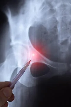 Doctor learn vertical X-ray image of big hernia in pelvic spine. Orthopedic.. 스톡 사진
