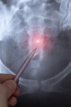 Doctor learn vertical X-ray image of big hernia in pelvic spine. Orthopedic.. Foto stock