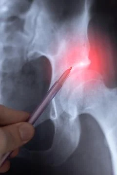 Doctor learn vertical X-ray image of big hernia in pelvic spine. Orthopedic.. Stock Photos