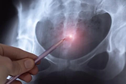 Doctor learn X-ray image of big hernia in pelvic spine. Orthopedic treatmen.. 스톡 사진