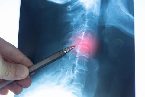 Doctor learning side X-ray scan with displacement of intervertebral discs a.. Stock Photos