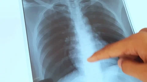The doctor is looking at a chest x-ray. Video stock 306227205