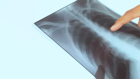 The doctor is looking at a chest x-ray. Stock Footage 306227334