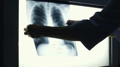 Doctor Looking At The Chest X-Rays Stock Footage