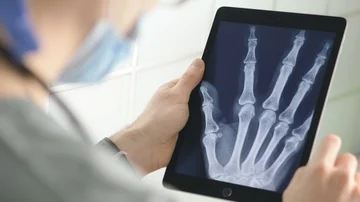 Doctor Looking at Digital X-Ray of Hands Bones on Tablet Stock Footage 86093918