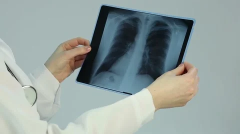 Doctor looking at pathology on chest x-ray, diagnosing patient with lung cancer Stock Footage 61309688