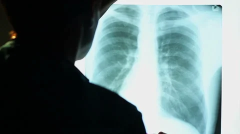 Doctor looking at X-ray image of human chest, scanning lungs 库存影片 40708941