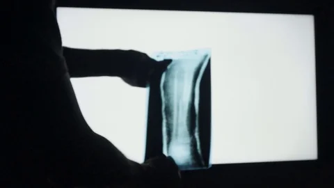 The doctor is looking x-ray image of bones fracture Stock Footage